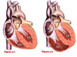 Cardiomiopatia aritmogena
