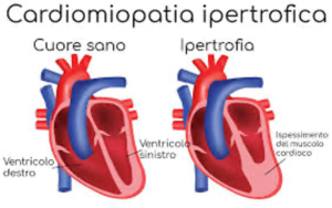 Cardiomiopatia Ipertrofica