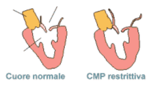 Cardiomiopatia Restrittiva