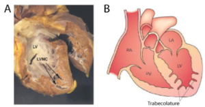 Ventricolo Sinistro non compatto Ventricolo Sinistro non compatto