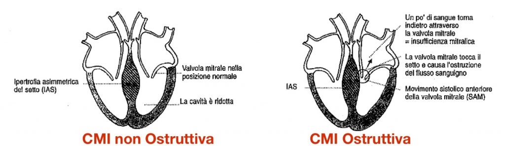 Cardiomiopatia Ipertrofica Ostruttiva