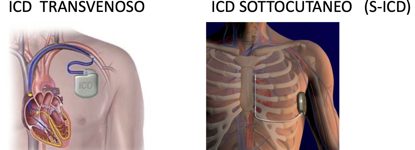 Defibrillatori impiantabili Defibrillatori impiantabili