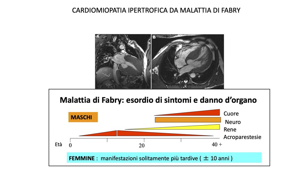 Malattia di Fabry