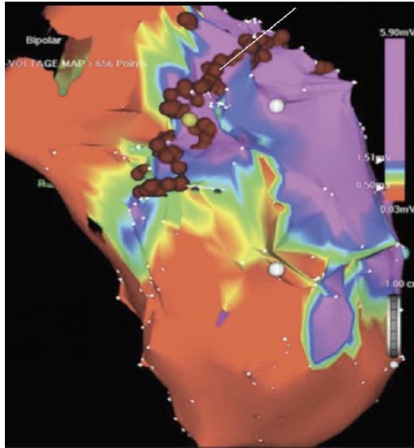 Mappaggio durante ablazione