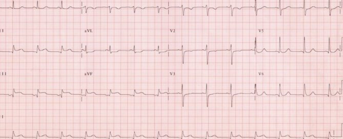 ecg progetto d-heart