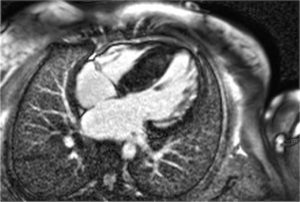 RMN Cardiaca